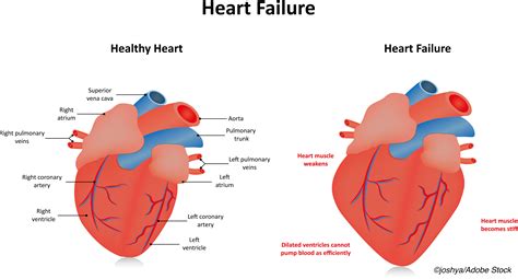 left ventricle not working